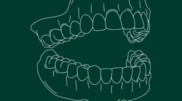 Prothèses dentaires complètes
