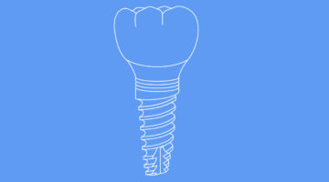 Implant Restorations