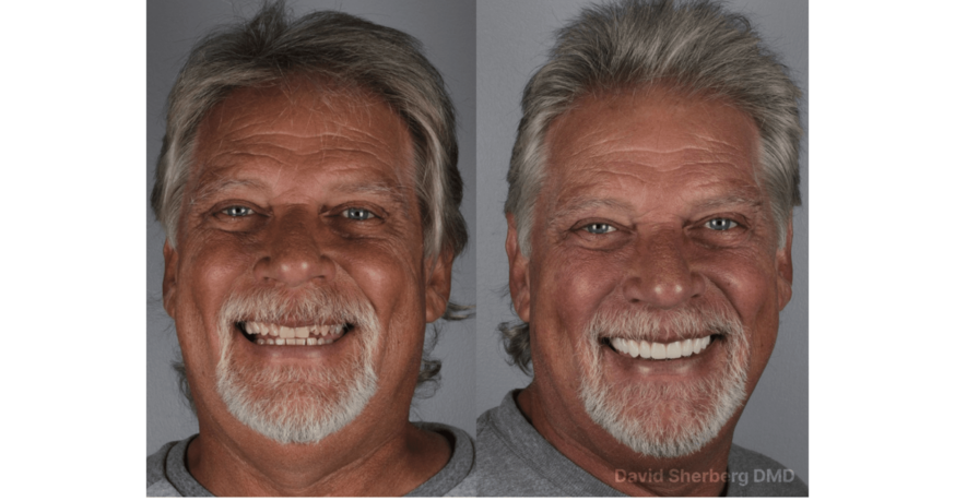 Case Study: 10-Unit Zirconia Smile Transformation